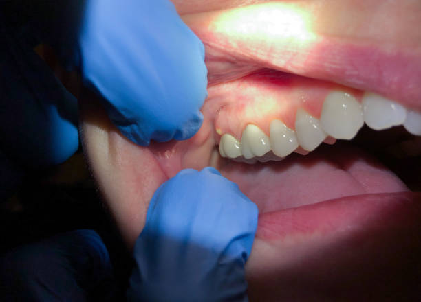 Best Knocked-Out Tooth (Avulsed Tooth) Treatment in Selma, NC